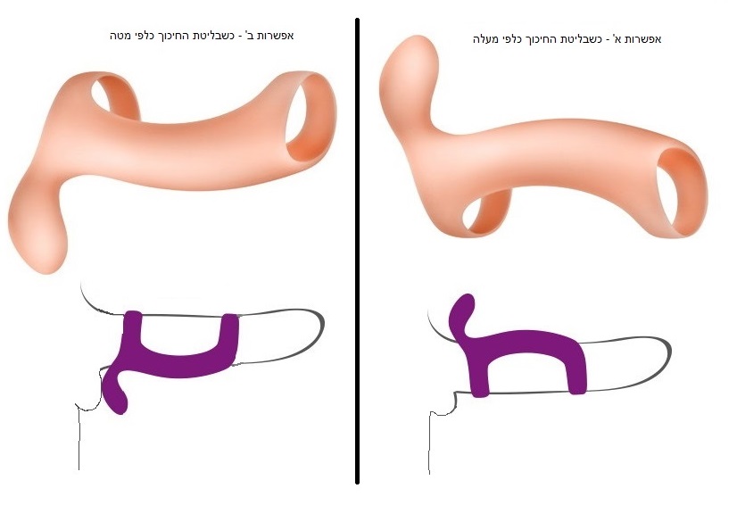 הלבשה סיליקונית תומכת ובליטה לדגדגן